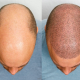 Hair Transplant Turkey Guide's user avatar